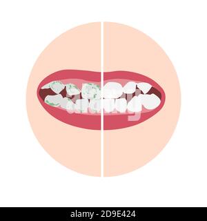 Denti bianchi sani con placca verde, batteri, virus. Illustrazione Vettoriale