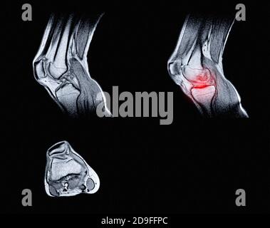 Imaging di risonanza magnetica (MRI) del ginocchio destro. Lesione chiusa dell'articolazione del ginocchio, con manifestazioni di artrosi. Un crunch nell'articolazione del ginocchio. Foto Stock