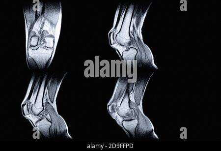 Imaging di risonanza magnetica (MRI) del ginocchio destro. Lesione chiusa dell'articolazione del ginocchio, con manifestazioni di artrosi. Foto Stock