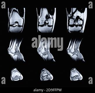 Imaging di risonanza magnetica (MRI) del ginocchio destro. Lesione chiusa dell'articolazione del ginocchio, con manifestazioni di artrosi. Foto Stock