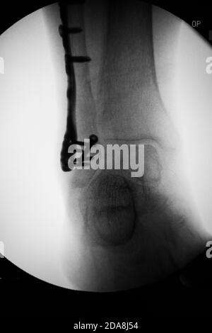 Un radiografia mostra una piastra di titanio che stabilizza una frattura della caviglia Foto Stock