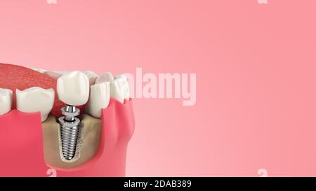 Dente umano singolo impianto concetto dentale denti umani o dentellature rendering 3d su gradiente di colore Foto Stock