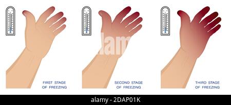 mano dell'uomo con diverse fasi di congelamento. Congelamento e danni alla pelle in inverno in aria fredda. Primo soccorso per l'ipotermia. Vettore Illustrazione Vettoriale