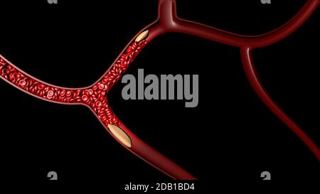 trombo 3d coagulo per la salute medica su rendering 3d nero Foto Stock