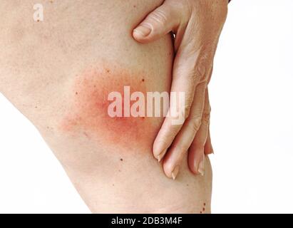 Arrossamento di una zecca di Lyme borreliosi malattia sulla gamba di una donna. Arrossamento della pelle sulla gamba dovuto ad un'allergia Foto Stock