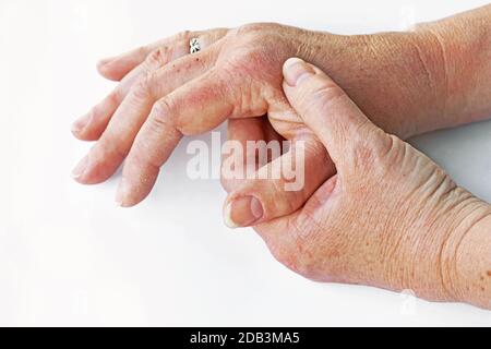 Una donna ha dolore nelle mani e le dita soffre dalla pelle asciutta Foto Stock