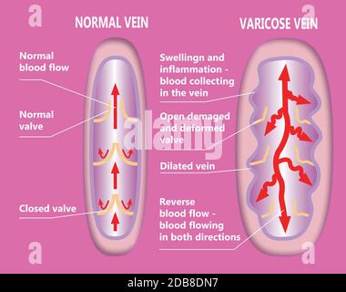 La struttura della vena astratta varicosa e della vena normale Foto Stock