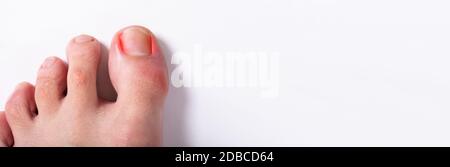 Toenail ingrown. Problema di chiodo infetto e irritato Foto Stock