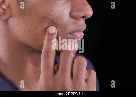 primo piano del viso del giovane uomo con problema di pelle . Foto Stock