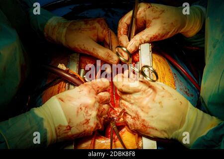 Paziente durante un intervento di cardiochirurgia in un ospedale del sala operatoria chirurgica Foto Stock