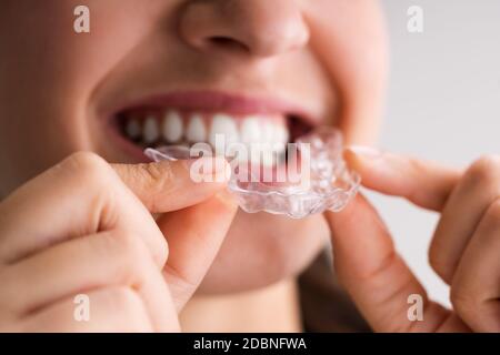 Cancellare la protezione notturna dentale dell'allineatore per i denti Foto Stock