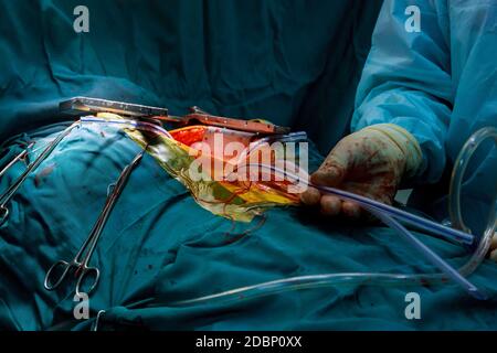 Lavoro di squadra i chirurghi durante la chirurgia a cuore aperto medico azienda strumenti chirurgici durante la procedura medica presso la clinica Foto Stock