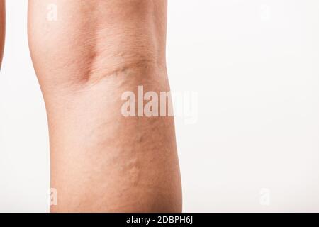 Primo piano giovane donna asiatica dolorosa varicose e vene ragno sulla gamba, studio girato isolato su sfondo bianco, sanitario medico e igiene corpo della pelle Foto Stock