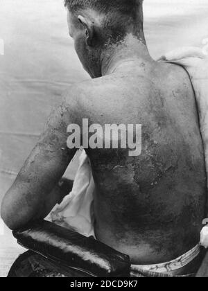 Ustard gas Burns, prima guerra mondiale Foto Stock