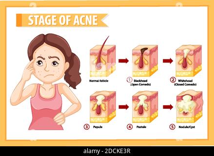 Fasi di anatomia dell'acne della pelle con una donna che fa stressante posa illustrazione Illustrazione Vettoriale