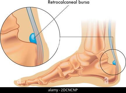 Illustrazione che mostra la posizione della borsa retrocalccanea nel piede, con un dettaglio ingrandito e un'annotazione. Illustrazione Vettoriale