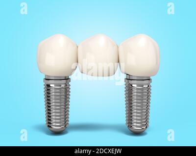 Dente umano ponte impianto dentale concetto dentale denti umani o protesi dentarie rendering 3d a più denti su gradiente blu Foto Stock