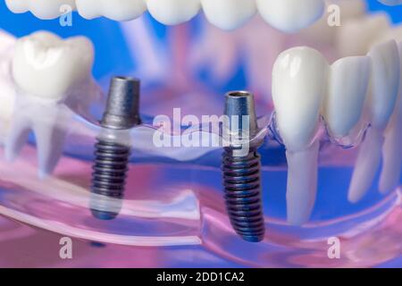 viti a ponte per impianti dentali nel modello a denti di mascella umani Foto Stock