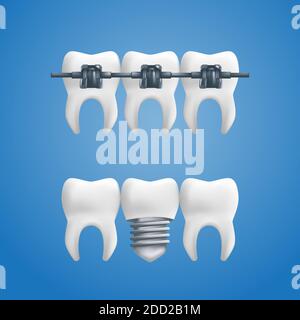 Concetto di dentista - denti sani con un impianto dentale e bretelle sopra di loro. Illustrazione vettoriale dei denti umani in uno stile 3D realistico isolato o Illustrazione Vettoriale