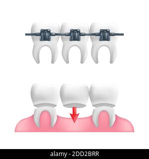 Concetto di dentista - denti sani con una bridgework dentale fissa e bretelle sopra di loro. Illustrazione vettoriale dei denti umani in uno stile 3d realistico i Illustrazione Vettoriale