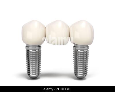 Dente umano ponte impianto dentale concetto dentale denti umani o protesi dentarie rendering 3d multitooth su bianco Foto Stock