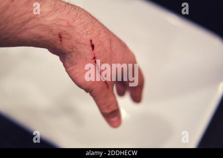 Mano graffiata da un gatto sopra il lavandino del bagno, sangue da vicino Foto Stock