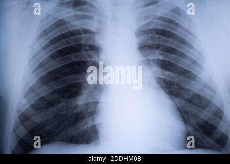 raggi x dei polmoni di un adolescente. Patologia polmonare. Radiografia frontale del torace di un bambino Foto Stock