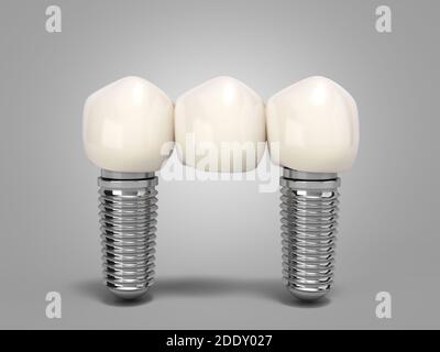 Dente umano ponte impianto dentale concetto dentale denti umani o protesi dentarie rendering 3d a più denti su gradiente grigio Foto Stock