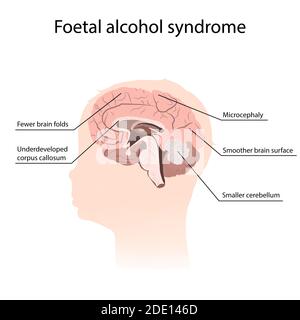 Sindrome da alcol fetale, illustrazione Foto Stock