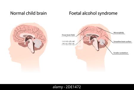 Sindrome da alcol fetale, illustrazione Foto Stock
