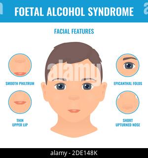 Sindrome da alcol fetale, illustrazione Foto Stock