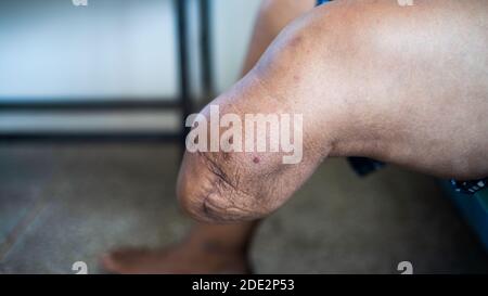 Sotto il ginocchio amputazione moncone e allenamento muscolare per protesi BK Foto Stock
