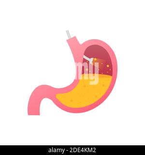 Endoscopia gastrica. Endoscopio nello stomaco attraverso esofago. Illustrazione di stock vettoriale. Illustrazione Vettoriale