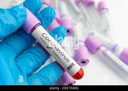 Il medico tiene in mano un campione di analisi del sangue positivo per il coronavirus. Concetto Covid-19. Coronavirus, epidemia di SARS-COV-2. Foto Stock