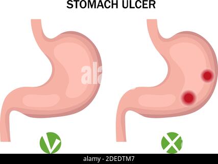 Ulcera gastrica e infografiche sane dello stomaco. Concetto di medicina. Illustrazione vettoriale Illustrazione Vettoriale