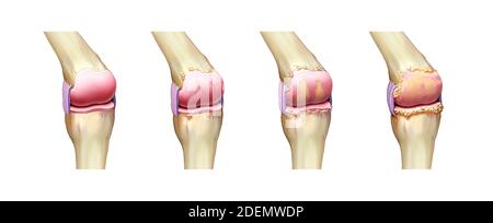 anatomia dell'artrite del ginocchio Foto Stock