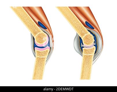 anatomia dell'artrite del ginocchio Foto Stock