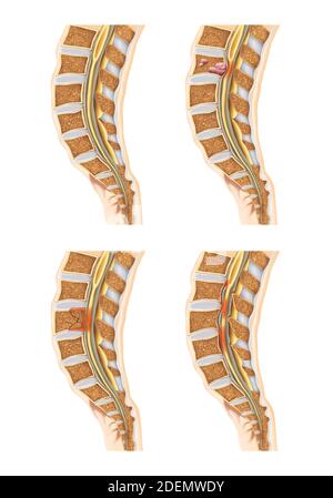 anatomia del disco spinale e lombare Foto Stock