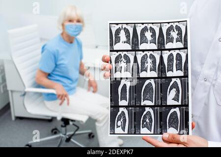 Pulmonologa che mostra la TAC dei polmoni pazienti anziani con polmonite. Complicazione dopo coronavirus. Malattia polmonare, fibrosi polmonare Foto Stock