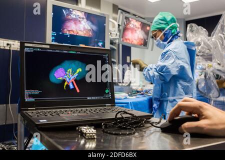La chirurgia renale conservativa robotica guidata da immagini assistita dalla modellazione 3D, questa modellazione 3D del rene con il suo tumore posizionato in viola, guida la s. Foto Stock