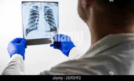 Raggi X dei polmoni umani su sfondo bianco nelle mani di un medico, immagine di polmonite polmonare, edema del tratto polmonare umano, primo piano. Foto Stock