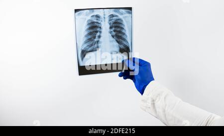 Un medico conduce un radiografia dei polmoni di una persona, il medico diagnostica ed esamina l'immagine dei polmoni, polmonite, edema. Foto Stock