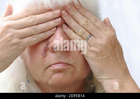 Una donna più anziana ha una cicatrice sul viso e si vergogna di esso. Con le cicatrici in faccia si vorrebbe nascondere Foto Stock