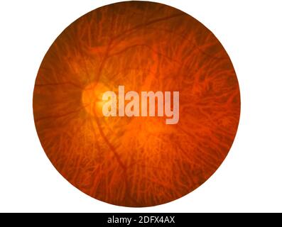 Retina del diabete , retinopatia diabetica,foto Medicina Retina anormale isolato su sfondo bianco.salvato con percorso di ritaglio Foto Stock