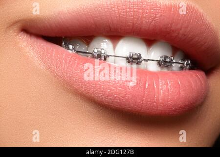 Bella ripresa macro di denti bianchi con bretelle. Per le cure dentarie foto. La bellezza della donna con sorriso ortodontic accessori. Ortodonzia trattamento. Primo piano della Foto Stock