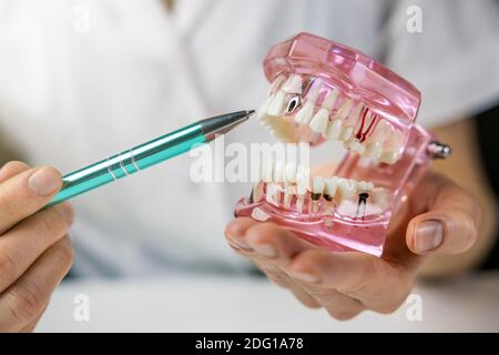 implantologo dentista che mostra la tecnologia dell'impianto dentale sulla mascella del dente umano modello Foto Stock