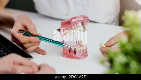 implantologo dentista che mostra al paziente la tecnologia dell'impianto dentale sul modello della mascella dentaria. visita in studio clinico Foto Stock