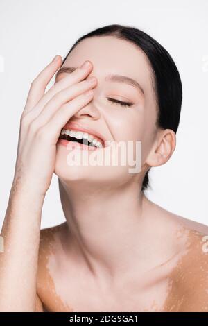 sorridente giovane bella donna con vitiligo isolato su bianco Foto Stock