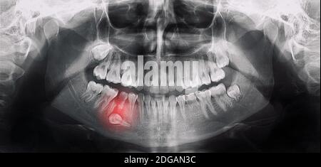 Ortopantomografia, OPG X-ray DR digitale denti saggezza Foto Stock