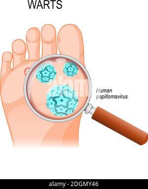 Le verruche del piede sono causate da infezione con un tipo di papillomavirus umano. Primo piano di HPV Illustrazione Vettoriale
